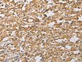 The image on the left is immunohistochemistry of paraffin-embedded Human thyroid cancer tissue using CSB-PA123263(ARHGEF1 Antibody) at dilution 1/50, on the right is treated with fusion protein. (Original magnification: ×200)