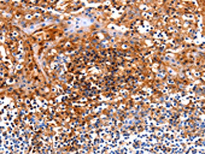 The image on the left is immunohistochemistry of paraffin-embedded Human tonsil tissue using CSB-PA123586(ICOS Antibody) at dilution 1/17, on the right is treated with fusion protein. (Original magnification: ×200)