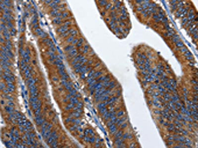 The image on the left is immunohistochemistry of paraffin-embedded Human colon cancer tissue using CSB-PA123791(CD27 Antibody) at dilution 1/60, on the right is treated with fusion protein. (Original magnification: ×200)