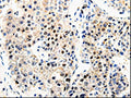 The image on the left is immunohistochemistry of paraffin-embedded Human liver cancer tissue using CSB-PA123968(APP Antibody) at dilution 1/100, on the right is treated with synthetic peptide. (Original magnification: ×200)