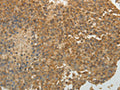 The image on the left is immunohistochemistry of paraffin-embedded Human liver cancer tissue using CSB-PA124064(SULT1E1 Antibody) at dilution 1/30, on the right is treated with fusion protein. (Original magnification: ×200)