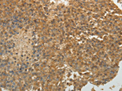 The image on the left is immunohistochemistry of paraffin-embedded Human liver cancer tissue using CSB-PA124064(SULT1E1 Antibody) at dilution 1/30, on the right is treated with fusion protein. (Original magnification: ×200)