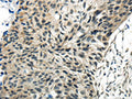 The image on the left is immunohistochemistry of paraffin-embedded Human esophagus cancer tissue using CSB-PA124592(SYNCRIP Antibody) at dilution 1/30, on the right is treated with synthetic peptide. (Original magnification: ×200)
