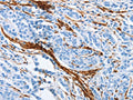 The image on the left is immunohistochemistry of paraffin-embedded Human prostate cancer tissue using CSB-PA125050(ACTA2 Antibody) at dilution 1/30, on the right is treated with synthetic peptide. (Original magnification: ×200)