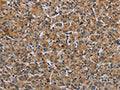 The image on the left is immunohistochemistry of paraffin-embedded Human prostate cancer tissue using CSB-PA125161(IL31RA Antibody) at dilution 1/30, on the right is treated with fusion protein. (Original magnification: ×200)