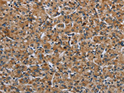 The image on the left is immunohistochemistry of paraffin-embedded Human prostate cancer tissue using CSB-PA125161(IL31RA Antibody) at dilution 1/30, on the right is treated with fusion protein. (Original magnification: ×200)