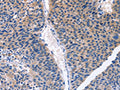 The image on the left is immunohistochemistry of paraffin-embedded Human liver cancer tissue using CSB-PA125315(CDK2 Antibody) at dilution 1/30, on the right is treated with fusion protein. (Original magnification: ×200)