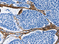 The image on the left is immunohistochemistry of paraffin-embedded Human lung cancer tissue using CSB-PA125350(COL3A1 Antibody) at dilution 1/60, on the right is treated with fusion protein. (Original magnification: ×200)