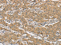 The image on the left is immunohistochemistry of paraffin-embedded Human gastic cancer tissue using CSB-PA126192(AMZ2 Antibody) at dilution 1/60, on the right is treated with fusion protein. (Original magnification: ×200)