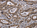The image on the left is immunohistochemistry of paraffin-embedded Human gastic cancer tissue using CSB-PA126732(DUSP4 Antibody) at dilution 1/40, on the right is treated with fusion protein. (Original magnification: ×200)