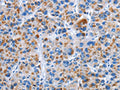 The image on the left is immunohistochemistry of paraffin-embedded Human liver cancer tissue using CSB-PA127200(CENPJ Antibody) at dilution 1/40, on the right is treated with fusion protein. (Original magnification: ×200)