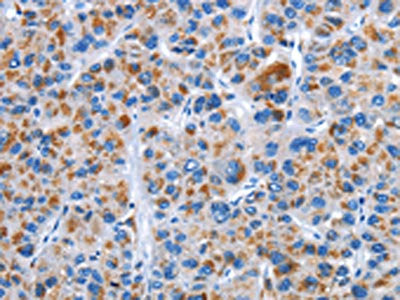 The image on the left is immunohistochemistry of paraffin-embedded Human liver cancer tissue using CSB-PA127200(CENPJ Antibody) at dilution 1/40, on the right is treated with fusion protein. (Original magnification: ×200)