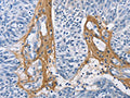 The image on the left is immunohistochemistry of paraffin-embedded Human ovarian cancer tissue using CSB-PA127242(COL3A1 Antibody) at dilution 1/60, on the right is treated with fusion protein. (Original magnification: ×200)