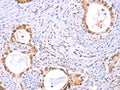 The image on the left is immunohistochemistry of paraffin-embedded Human cervical cancer tissue using CSB-PA127412(PROS1 Antibody) at dilution 1/60, on the right is treated with fusion protein. (Original magnification: ×200)
