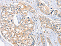 The image on the left is immunohistochemistry of paraffin-embedded Human breast cancer tissue using CSB-PA127416(FAIM3 Antibody) at dilution 1/20, on the right is treated with fusion protein. (Original magnification: ×200)