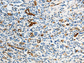 The image on the left is immunohistochemistry of paraffin-embedded Human gastic cancer tissue using CSB-PA127583(ABCG1 Antibody) at dilution 1/40, on the right is treated with synthetic peptide. (Original magnification: ×200)