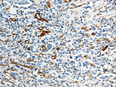 The image on the left is immunohistochemistry of paraffin-embedded Human gastic cancer tissue using CSB-PA127583(ABCG1 Antibody) at dilution 1/40, on the right is treated with synthetic peptide. (Original magnification: ×200)