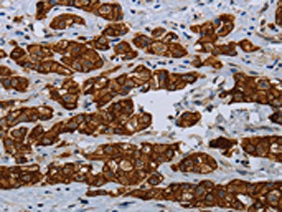 The image on the left is immunohistochemistry of paraffin-embedded Human breast cancer tissue using CSB-PA127808(COX6B2 Antibody) at dilution 1/35, on the right is treated with fusion protein. (Original magnification: ×200)