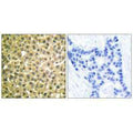Immunohistochemical analysis of paraffin-embedded human breast carcinoma tissue using Retinoic Acid Receptor β antibody.