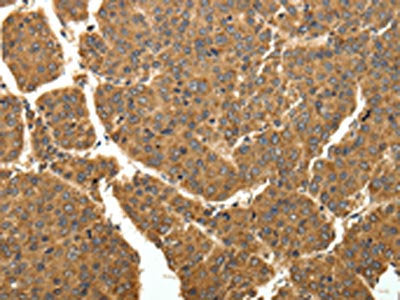The image on the left is immunohistochemistry of paraffin-embedded Human liver cancer tissue using CSB-PA127898(EIF2AK3 Antibody) at dilution 1/40, on the right is treated with fusion protein. (Original magnification: ×200)
