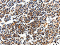 The image on the left is immunohistochemistry of paraffin-embedded Human tonsil tissue using CSB-PA128065(CAMK1 Antibody) at dilution 1/10, on the right is treated with fusion protein. (Original magnification: ×200)