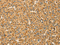 The image on the left is immunohistochemistry of paraffin-embedded Human liver cancer tissue using CSB-PA128390(CAPN7 Antibody) at dilution 1/20, on the right is treated with fusion protein. (Original magnification: ×200)