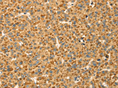 The image on the left is immunohistochemistry of paraffin-embedded Human liver cancer tissue using CSB-PA128390(CAPN7 Antibody) at dilution 1/20, on the right is treated with fusion protein. (Original magnification: ×200)