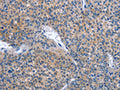 The image on the left is immunohistochemistry of paraffin-embedded Human liver cancer tissue using CSB-PA128816(IBSP Antibody) at dilution 1/30, on the right is treated with synthetic peptide. (Original magnification: ×200)