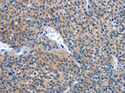 The image on the left is immunohistochemistry of paraffin-embedded Human liver cancer tissue using CSB-PA128816(IBSP Antibody) at dilution 1/30, on the right is treated with synthetic peptide. (Original magnification: ×200)