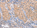 The image on the left is immunohistochemistry of paraffin-embedded Human cervical cancer tissue using CSB-PA129011(ACADS Antibody) at dilution 1/15, on the right is treated with fusion protein. (Original magnification: ×200)