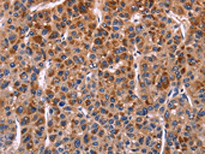 The image on the left is immunohistochemistry of paraffin-embedded Human liver cancer tissue using CSB-PA129120(SELPLG Antibody) at dilution 1/50, on the right is treated with fusion protein. (Original magnification: ×200)