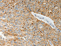 The image on the left is immunohistochemistry of paraffin-embedded Human ovarian cancer tissue using CSB-PA129196(COL4A3 Antibody) at dilution 1/20, on the right is treated with synthetic peptide. (Original magnification: ×200)