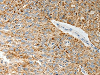 The image on the left is immunohistochemistry of paraffin-embedded Human ovarian cancer tissue using CSB-PA129196(COL4A3 Antibody) at dilution 1/20, on the right is treated with synthetic peptide. (Original magnification: ×200)