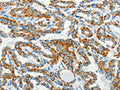 The image on the left is immunohistochemistry of paraffin-embedded Human thyroid cancer tissue using CSB-PA129399(BCAT2 Antibody) at dilution 1/50, on the right is treated with fusion protein. (Original magnification: ×200)