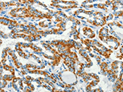 The image on the left is immunohistochemistry of paraffin-embedded Human thyroid cancer tissue using CSB-PA129399(BCAT2 Antibody) at dilution 1/50, on the right is treated with fusion protein. (Original magnification: ×200)