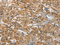 The image on the left is immunohistochemistry of paraffin-embedded Human thyroid cancer tissue using CSB-PA129637(FASLG Antibody) at dilution 1/30, on the right is treated with synthetic peptide. (Original magnification: ×200)