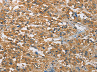 The image on the left is immunohistochemistry of paraffin-embedded Human thyroid cancer tissue using CSB-PA129637(FASLG Antibody) at dilution 1/30, on the right is treated with synthetic peptide. (Original magnification: ×200)