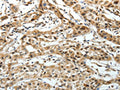 The image on the left is immunohistochemistry of paraffin-embedded Human lung cancer tissue using CSB-PA129862(FZD3 Antibody) at dilution 1/20, on the right is treated with synthetic peptide. (Original magnification: ×200)
