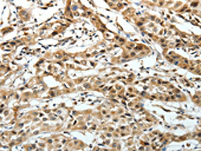The image on the left is immunohistochemistry of paraffin-embedded Human lung cancer tissue using CSB-PA129862(FZD3 Antibody) at dilution 1/20, on the right is treated with synthetic peptide. (Original magnification: ×200)