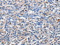The image on the left is immunohistochemistry of paraffin-embedded Human thyroid cancer tissue using CSB-PA130040(PIM1 Antibody) at dilution 1/50, on the right is treated with fusion protein. (Original magnification: ×200)