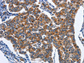 The image on the left is immunohistochemistry of paraffin-embedded Human breast cancer tissue using CSB-PA130108(CADM3 Antibody) at dilution 1/40, on the right is treated with fusion protein. (Original magnification: ×200)