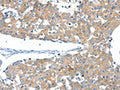 The image on the left is immunohistochemistry of paraffin-embedded Human breast cancer tissue using CSB-PA130335(SSTR3 Antibody) at dilution 1/40, on the right is treated with synthetic peptide. (Original magnification: ×200)