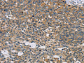 The image on the left is immunohistochemistry of paraffin-embedded Human cervical cancer tissue using CSB-PA130463(STAT4 Antibody) at dilution 1/30, on the right is treated with fusion protein. (Original magnification: ×200)