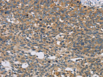 The image on the left is immunohistochemistry of paraffin-embedded Human cervical cancer tissue using CSB-PA130463(STAT4 Antibody) at dilution 1/30, on the right is treated with fusion protein. (Original magnification: ×200)