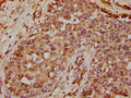 IHC image of CSB-PA13057A0Rb diluted at 1:400 and staining in paraffin-embedded human breast cancer performed on a Leica BondTM system. After dewaxing and hydration, antigen retrieval was mediated by high pressure in a citrate buffer (pH 6.0). Section was blocked with 10% normal goat serum 30min at RT. Then primary antibody (1% BSA) was incubated at 4°C overnight. The primary is detected by a biotinylated secondary antibody and visualized using an HRP conjugated SP system.