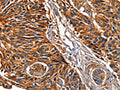The image on the left is immunohistochemistry of paraffin-embedded Human esophagus cancer tissue using CSB-PA130656(LGALS8 Antibody) at dilution 1/50, on the right is treated with fusion protein. (Original magnification: ×200)
