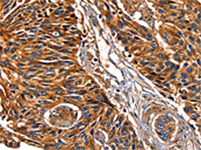 The image on the left is immunohistochemistry of paraffin-embedded Human esophagus cancer tissue using CSB-PA130656(LGALS8 Antibody) at dilution 1/50, on the right is treated with fusion protein. (Original magnification: ×200)