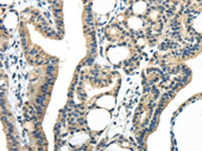 The image on the left is immunohistochemistry of paraffin-embedded Human thyroid cancer tissue using CSB-PA130699(IL-20 Antibody) at dilution 1/35, on the right is treated with synthetic peptide. (Original magnification: ×200)