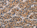 The image on the left is immunohistochemistry of paraffin-embedded Human liver cancer tissue using CSB-PA130815(CD80 Antibody) at dilution 1/25, on the right is treated with synthetic peptide. (Original magnification: ×200)