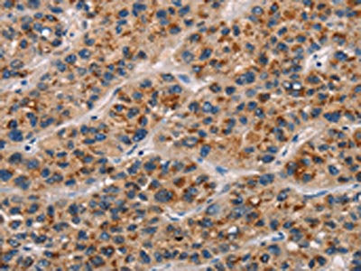 The image on the left is immunohistochemistry of paraffin-embedded Human liver cancer tissue using CSB-PA130815(CD80 Antibody) at dilution 1/25, on the right is treated with synthetic peptide. (Original magnification: ×200)